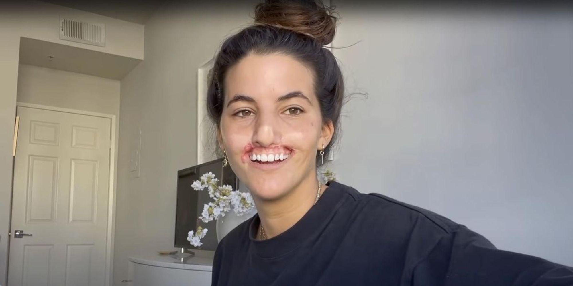 Model Brooklinn Khoury gets new lip after horror dog attack tore off