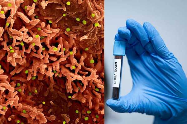 Foreign 'Fauci acolyte' and his African crony charged with smuggling monkeypox onto American soil