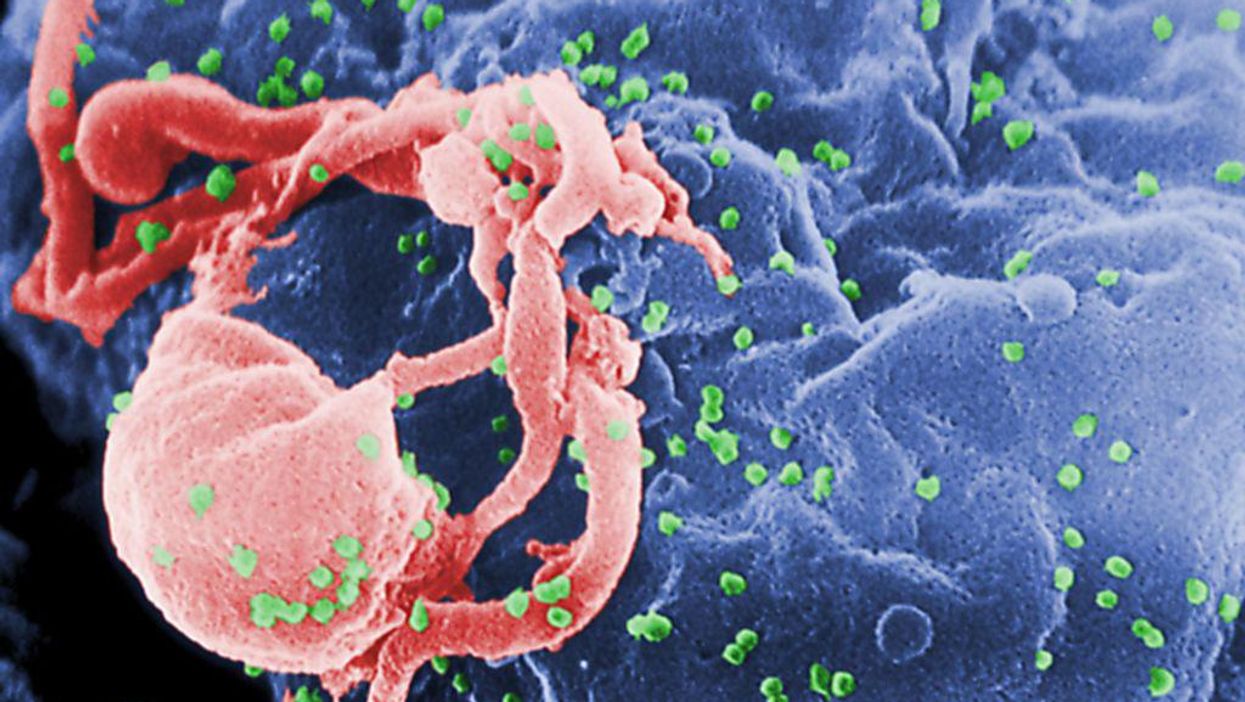 'Hope patient' from Argentina possibly cured of HIV after her body fought it off