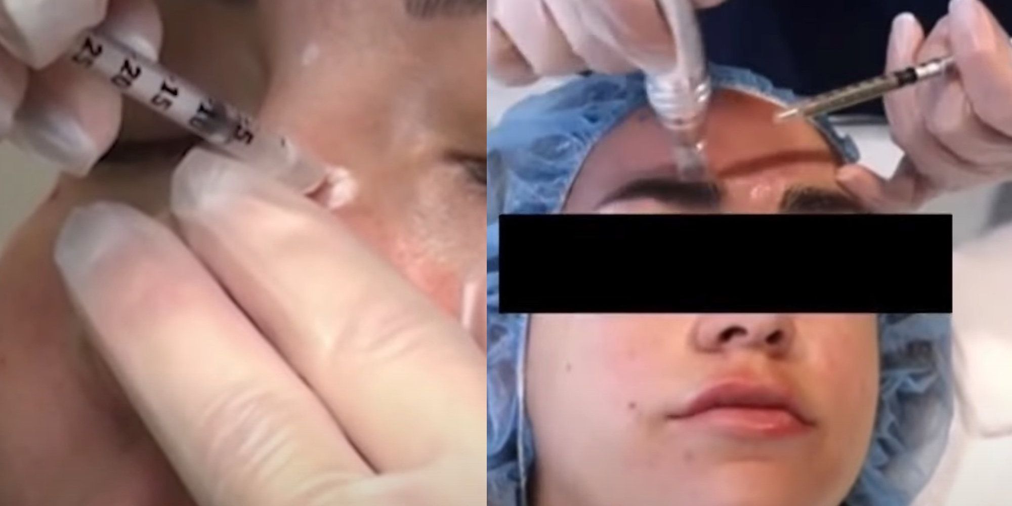 As many as 59 women were exposed to HIV infection over 'vampire facials' and Botox injections, health officials say - Vimarsana News