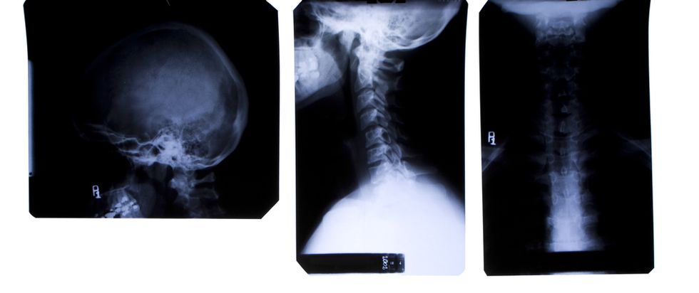 Doctors Baffled by Random Object Revealed in X-Ray to Be Lodged Inside Patient's Throat