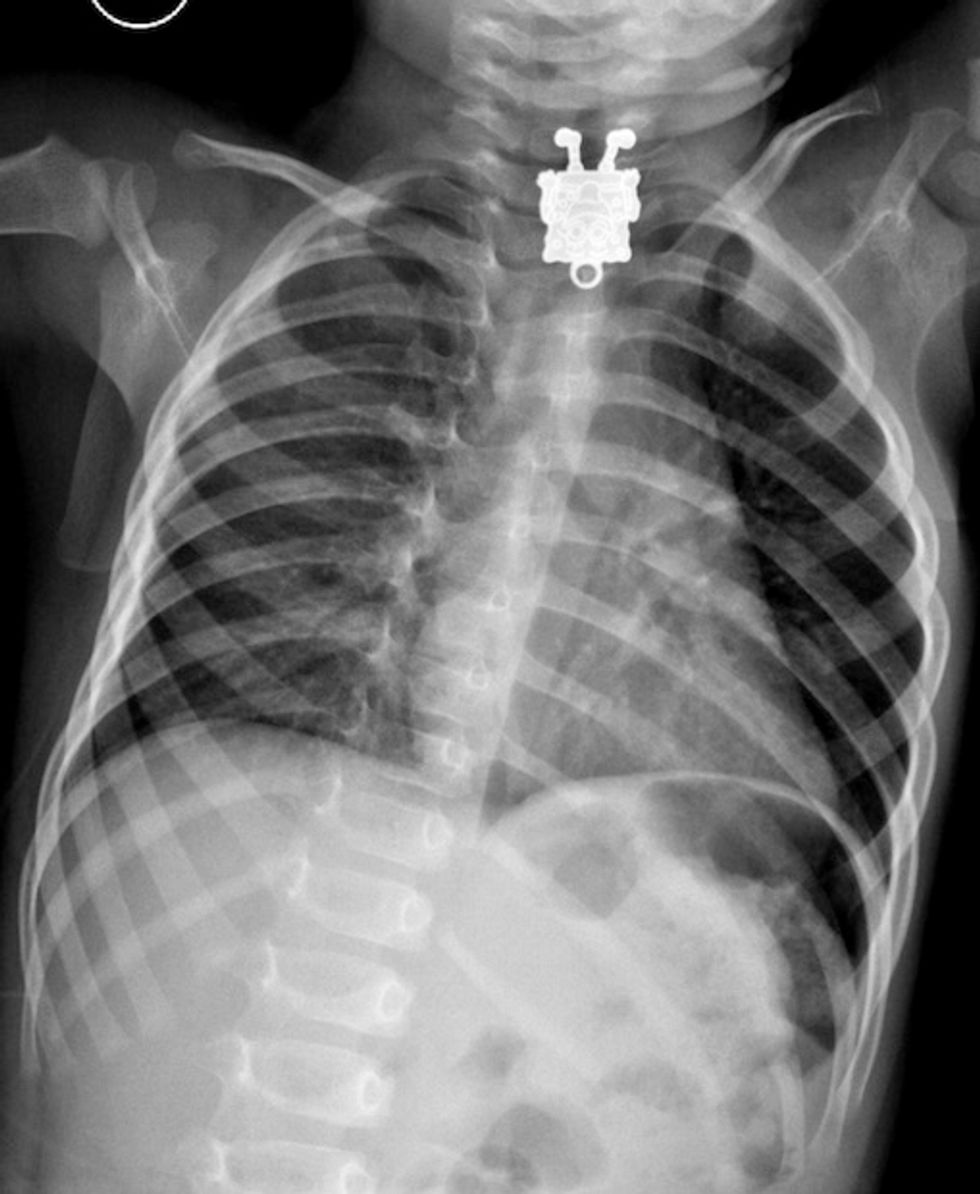 The Tiny Object That Appeared on a Child's X-Ray Reportedly Made the Doctor Scream