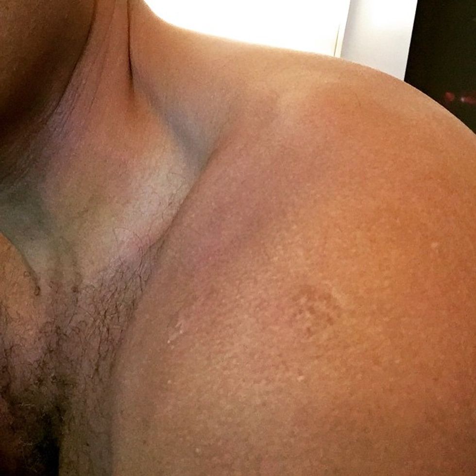 CNN Anchor Tweets Out Photo of 'Measles Shot Scar,' Then Realizes He Made a Mistake