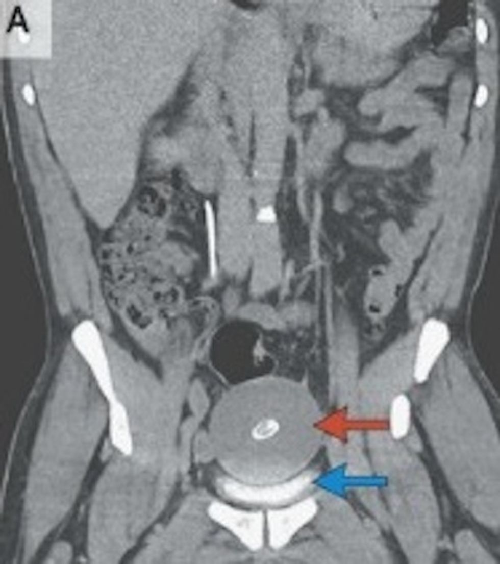 For Over 20 Years a Man Went to the Bathroom Too Often. When Doctors Investigated They Found Something Fascinatingly Gross.