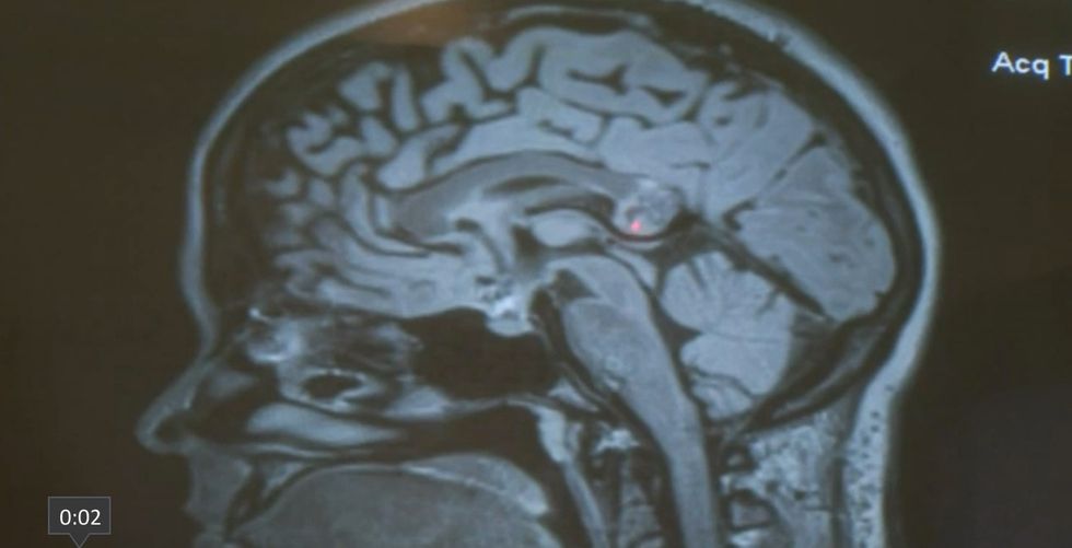 Woman Undergoes Brain Surgery to Remove Tumor, and Even the Doctors Were Stunned by Rare Discovery They Made