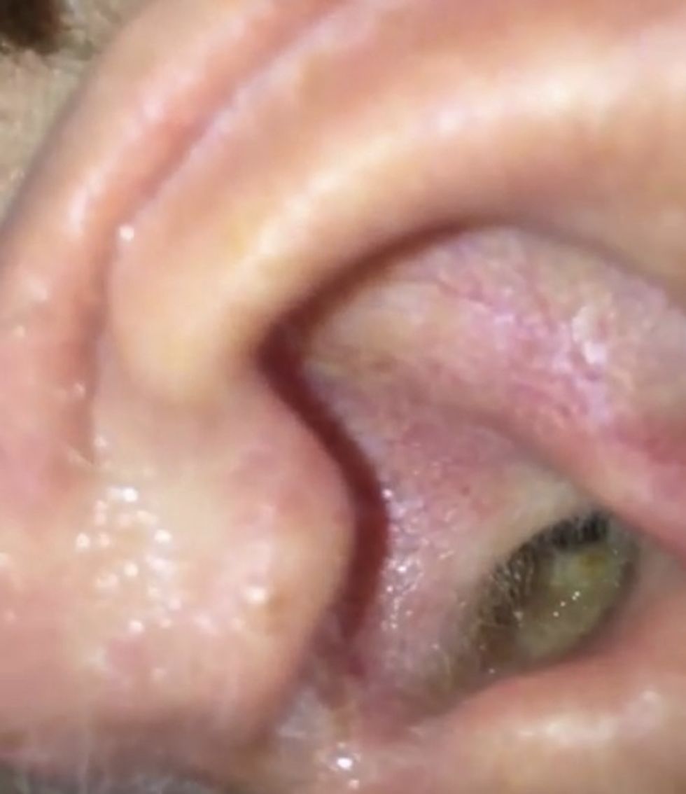 Hit With a Painful Ear Infection, He Takes a Closeup Peek With His Cellphone Video. What Happens Next Might Gross You Out.