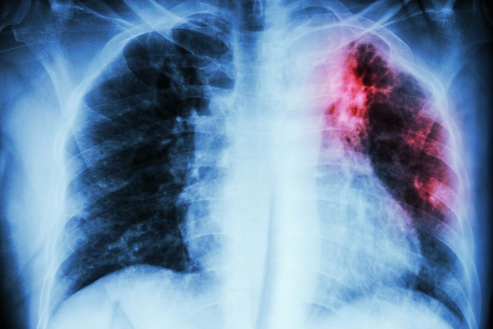 Feds Scrambling to Notify Individuals Who May Have Been Exposed to Patient With Extreme TB