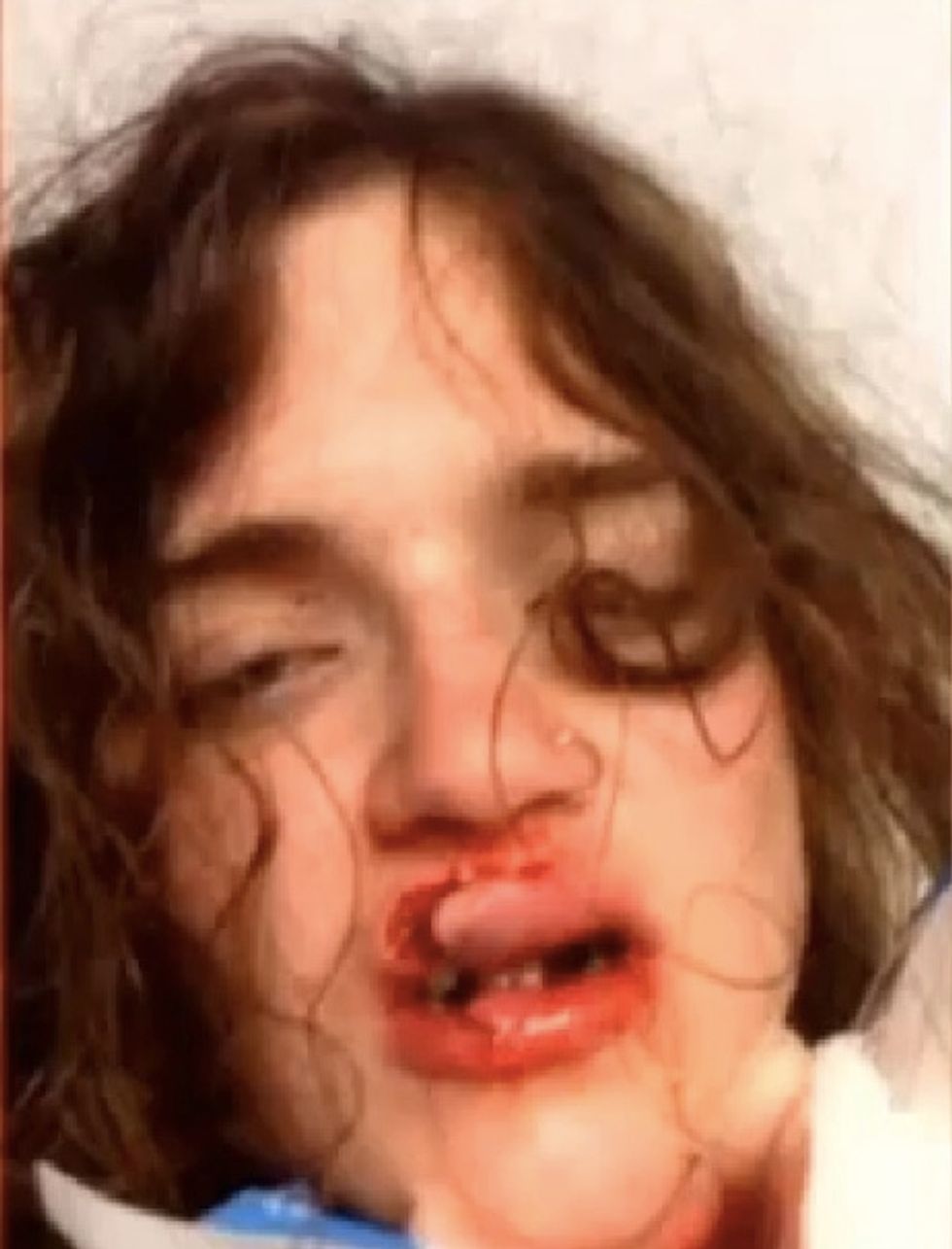 After Her Boyfriend Fights Catcalling Thugs, One of Them Allegedly Throws Brass Pipe at Her Face
