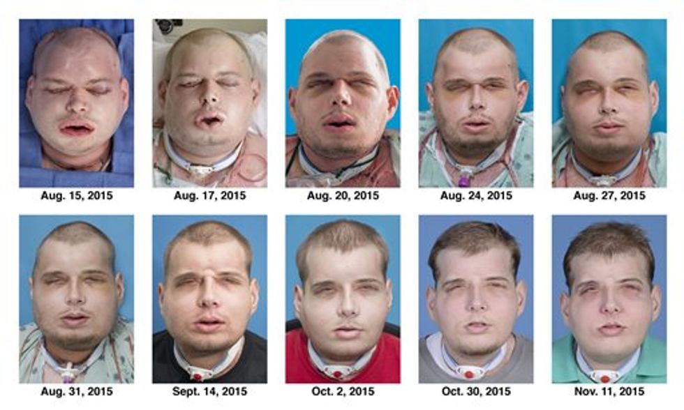 Firefighter's Face Was 'One Huge Scar' After He Was Badly Burned. Now He's Received the Most Extensive Face Transplant to Date