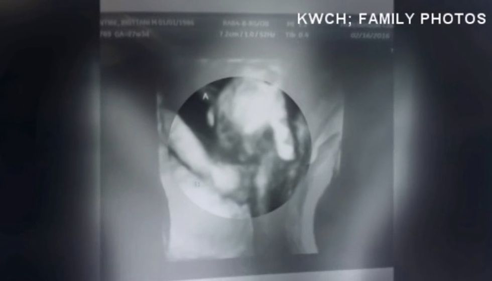 Sonogram Reveals Dying Twin Holding Unborn Sister's Hand