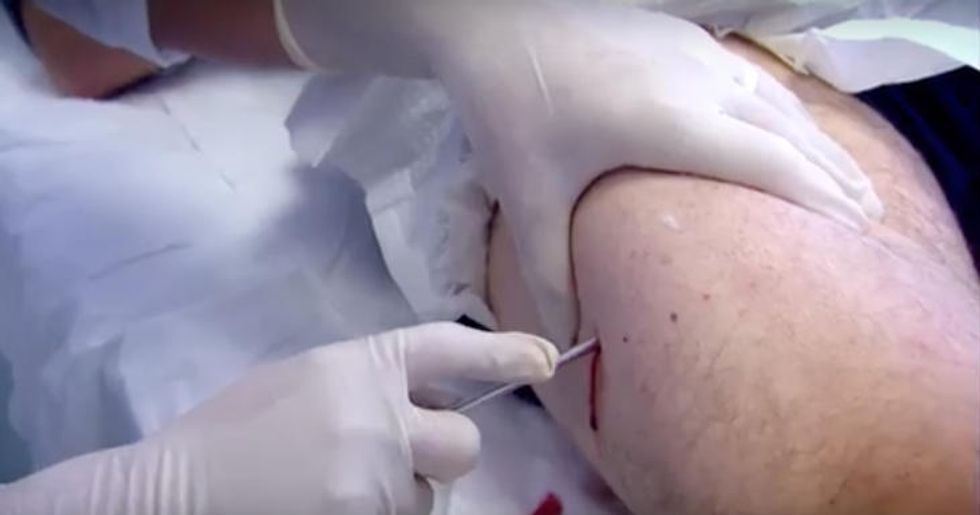 Man Has Part of His Leg Removed to See What Human Flesh Tastes Like — See His Reaction