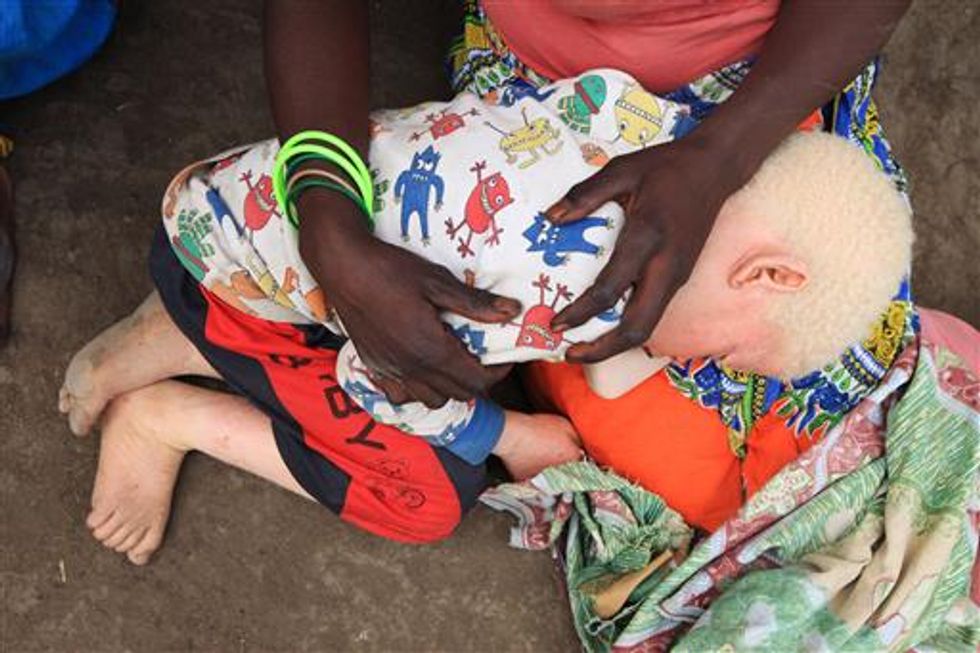 Malawi Sees Surge in Albino Murders; Victims Speak Out on the Deadly Trend