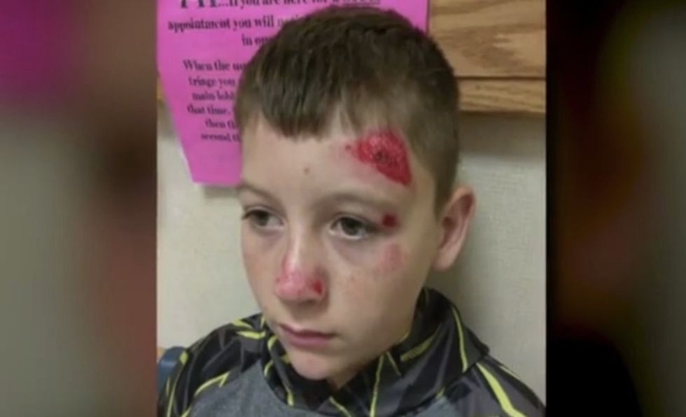 Stepmom of bullied student says school called after he 'fell.' Then she saw his bloody face and found out exactly how.