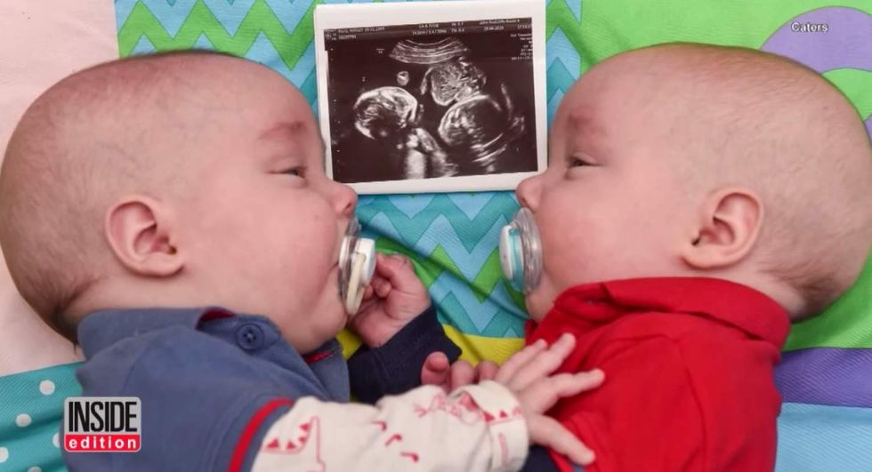Twin boys saved each other's lives by holding hands in their mother’s womb