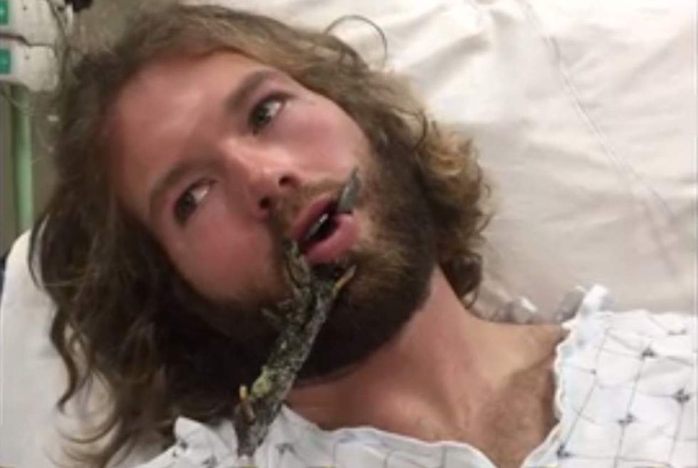 Ski instructor who impaled lip on tree branch thankful for Obamacare — but still requests donations