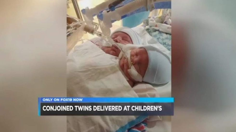 Couple rejects abortion for their conjoined twins: ‘To us, it wasn't an option’