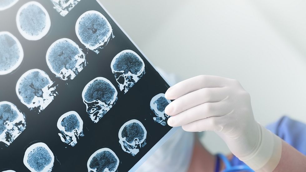 Scientists stumble upon treatment for Alzheimer's disease while testing Type 2 diabetes drug