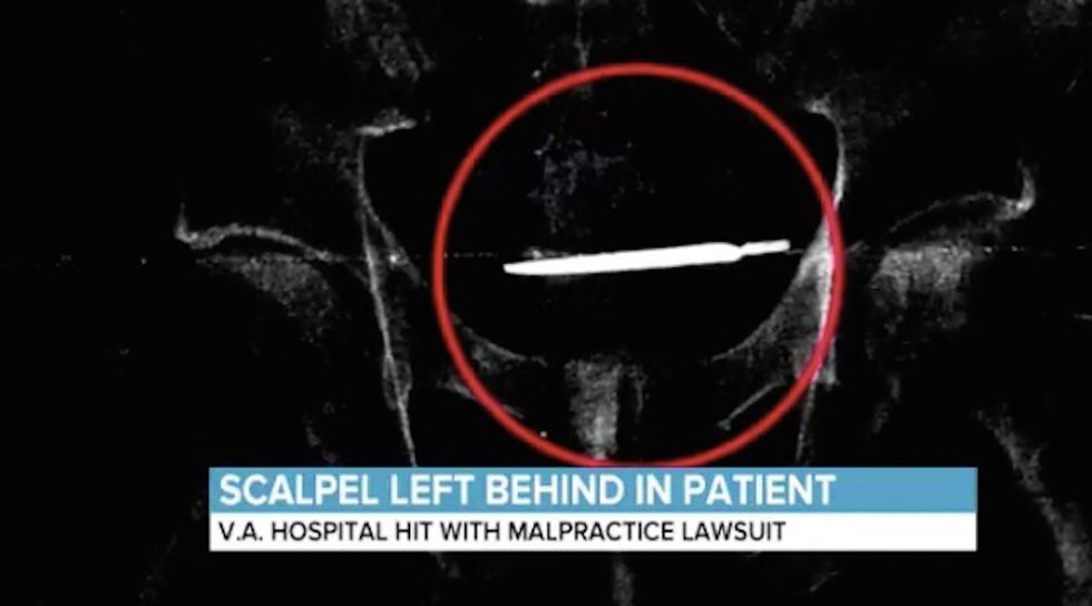 Army veteran says VA hospital left scalpel inside his abdomen for four years