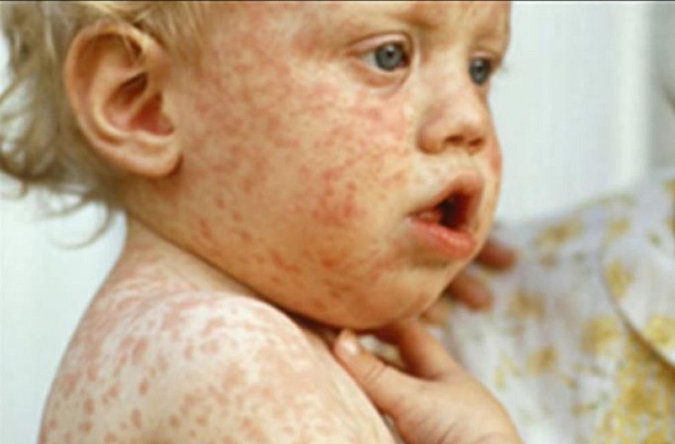 Measles cases in Europe spike to 10-year high, make a comeback following anti-vaccination campaigns