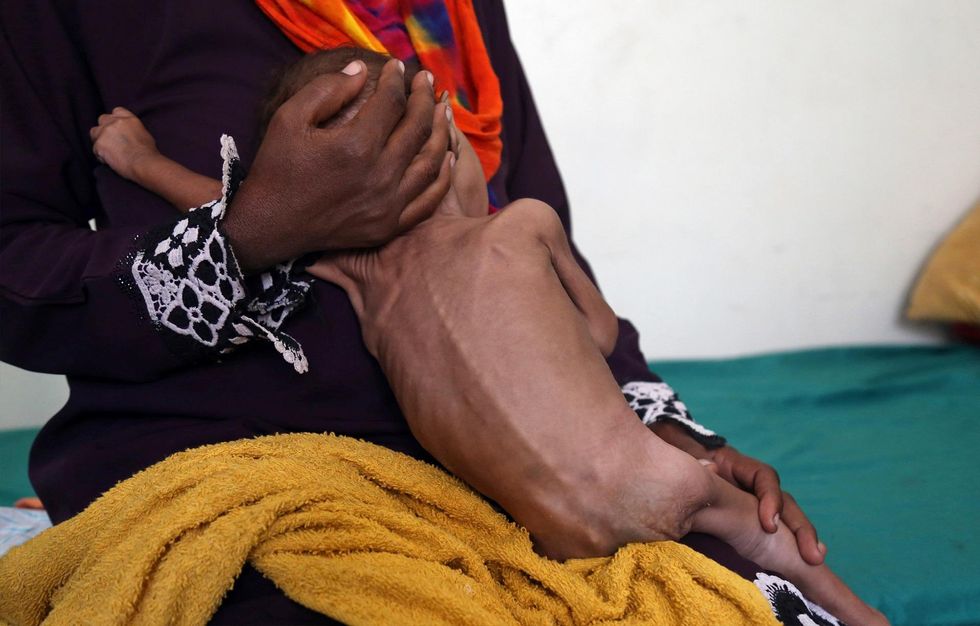 Report: 85,000 children under the age of 5 have died from starvation during war in Yemen
