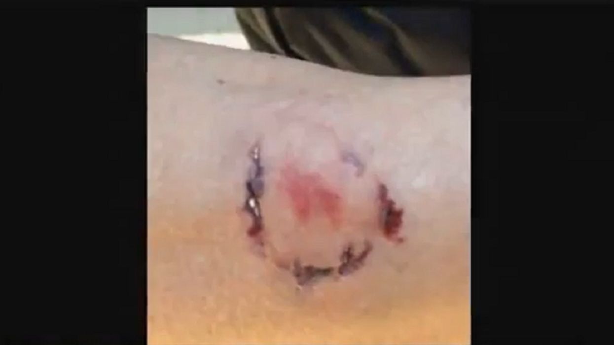 Jogger attacked by dog and then bitten by OWNER in Bay Area
