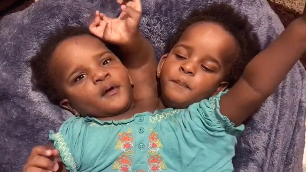 Father of conjoined twins faced with an unthinkable decision that could end one or both girls' lives