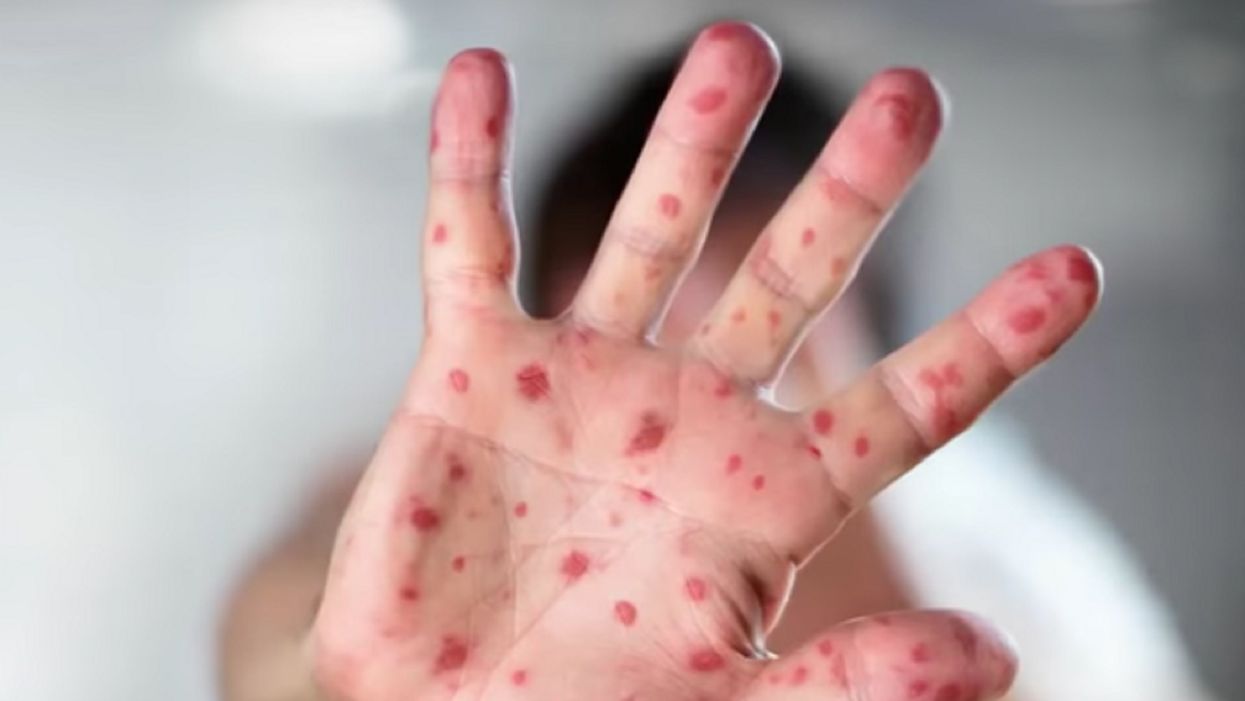 State lawmakers look to nix vaccine exemptions as U.S. fights measles outbreaks