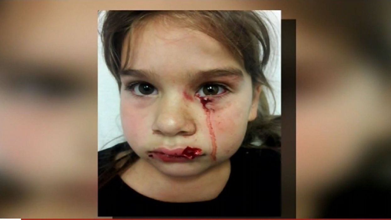 Lawsuit claims passenger's 'emotional support' pit bull mauls 5-year-old little girl in the face at Portland airport