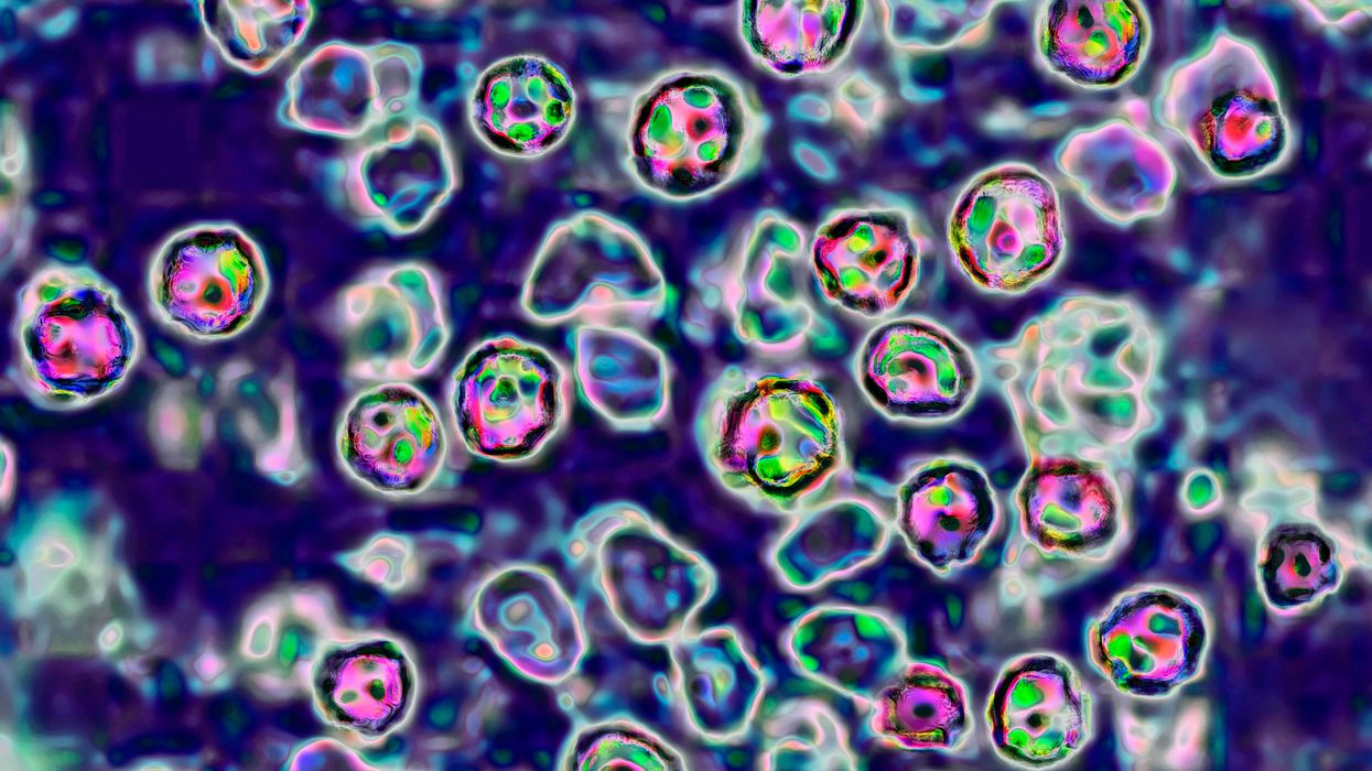 Number of measles cases in US hits 25-year-high