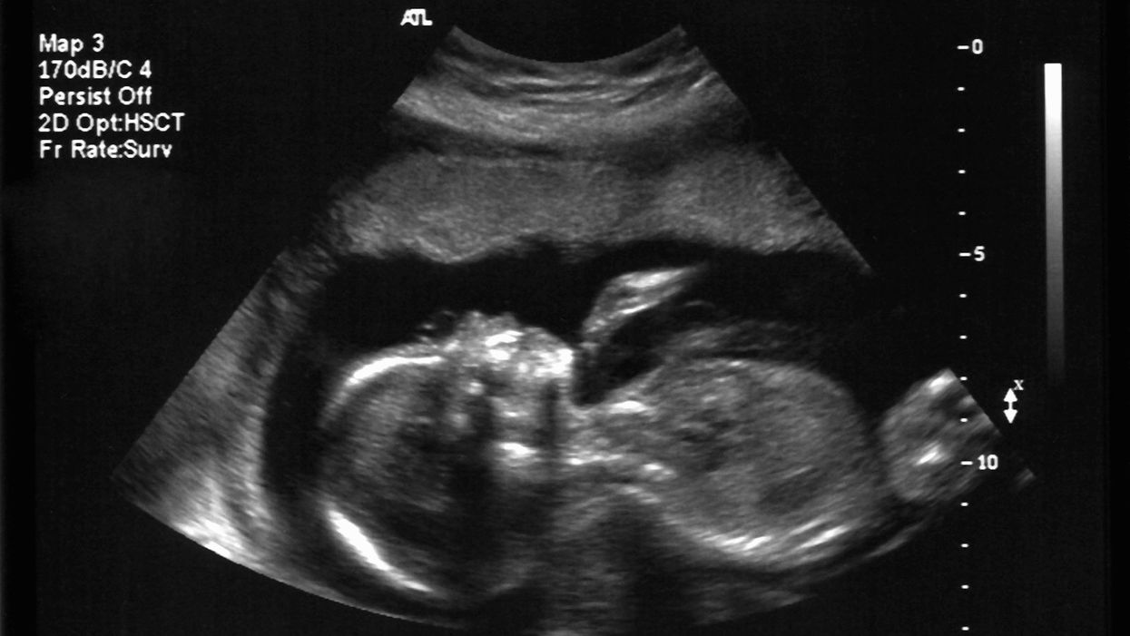 ACLU announces lawsuit in Tennessee over a city's pro-life zoning ordinance