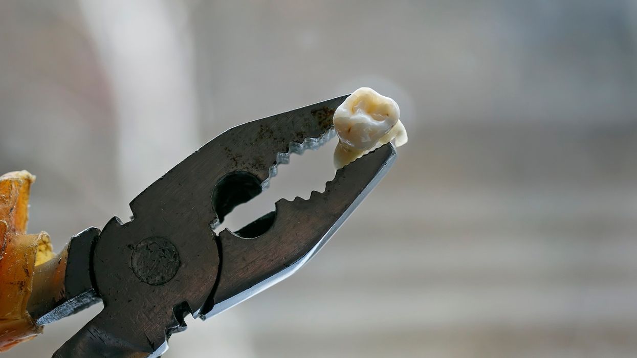 Man can't get dentist appointment during coronavirus lockdown, so he pulls his own tooth using pliers ... and whiskey