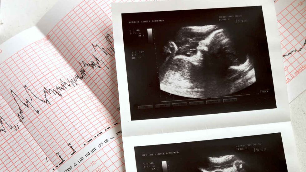 Supreme Court leaves Kentucky's pre-abortion ultrasound law in place