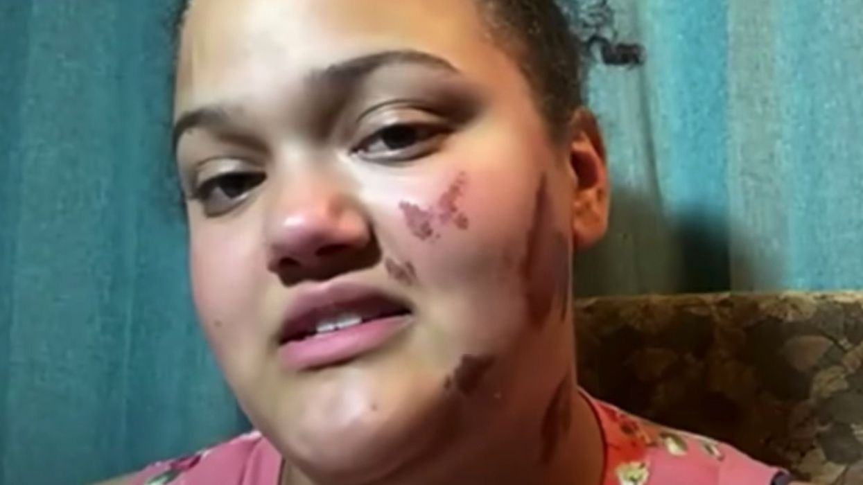 Biracial woman said four white males lit her on fire in racist attack — prosecutors found no evidence that it happened