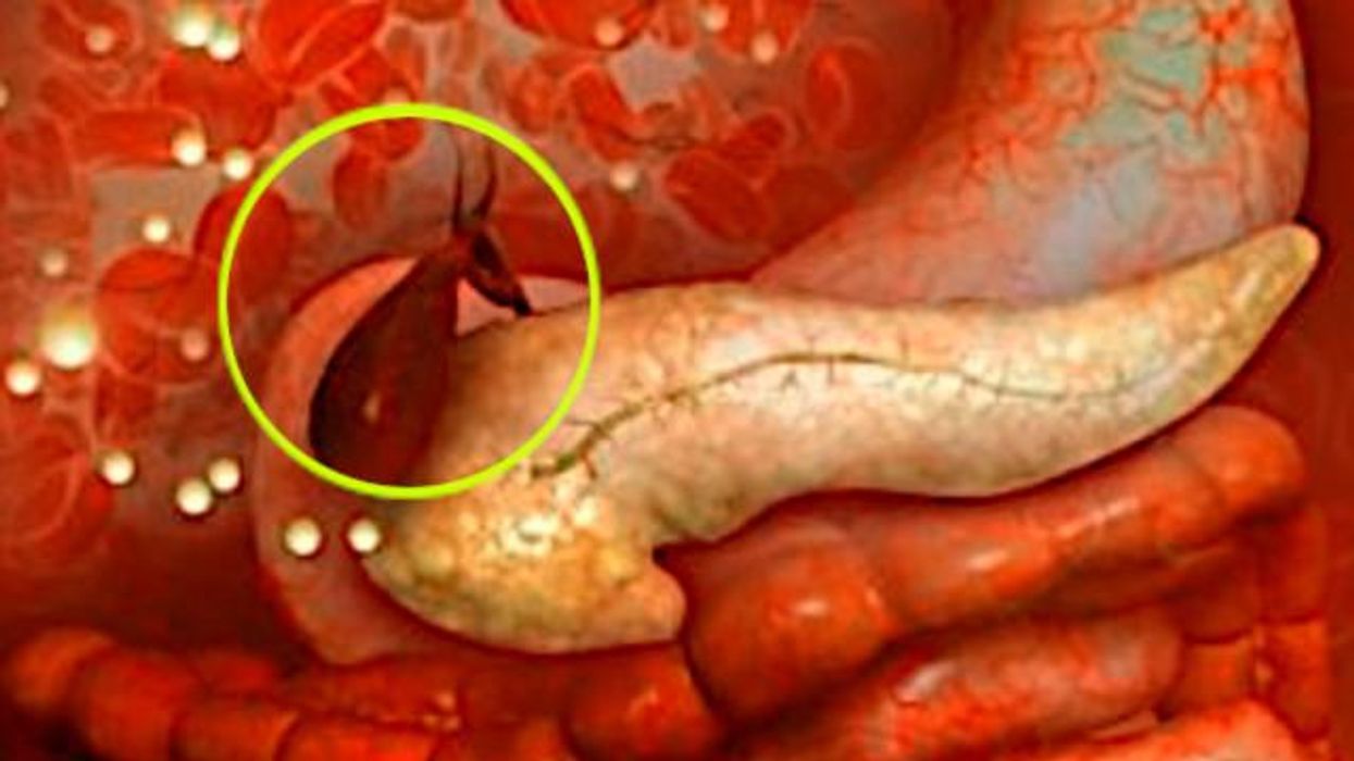 Why doctors 'in the know' no longer prescribe Metformin?