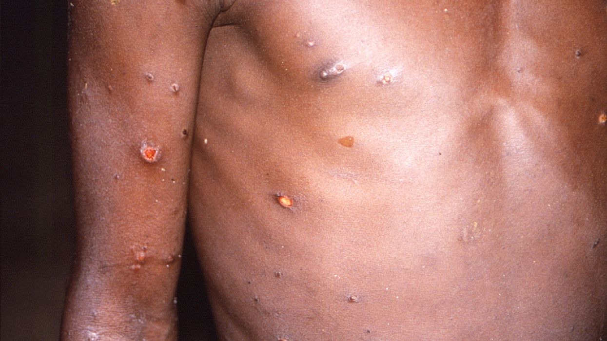 WHO expert says monkeypox outbreak may have emerged from sex at 2 different European raves