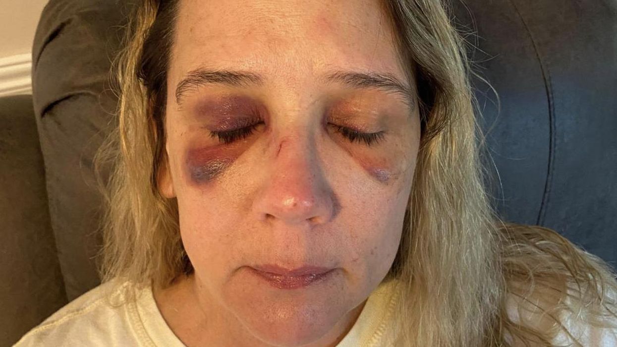 Mom says girls as young as 13 and 14 came to her home to fight her daughter but beat her up instead — giving her a concussion, broken nose, and black eyes