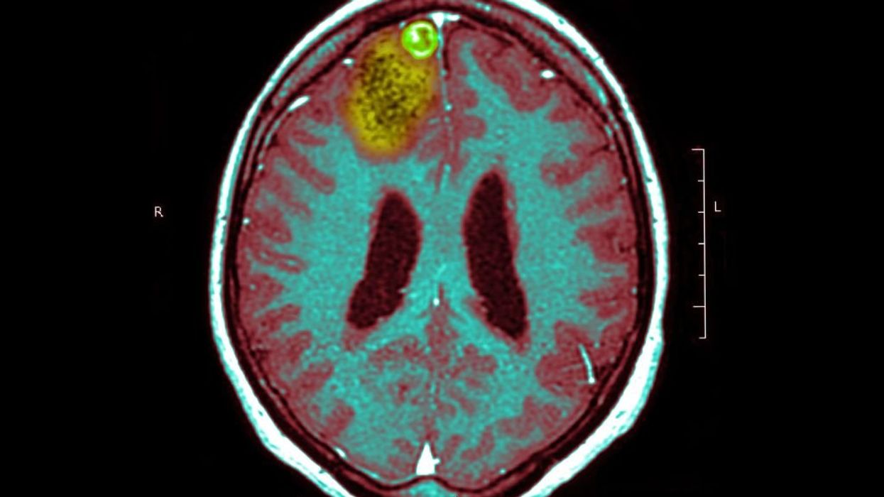 'I don't want to die': Doctor facing certain death from brain cancer tries friend's experimental treatment – which shows promise