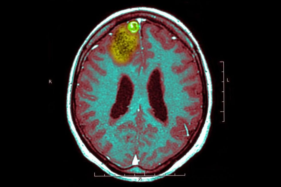 'I don't want to die'&colon; Doctor facing certain death from brain cancer tries friend's experimental treatment – which shows promise