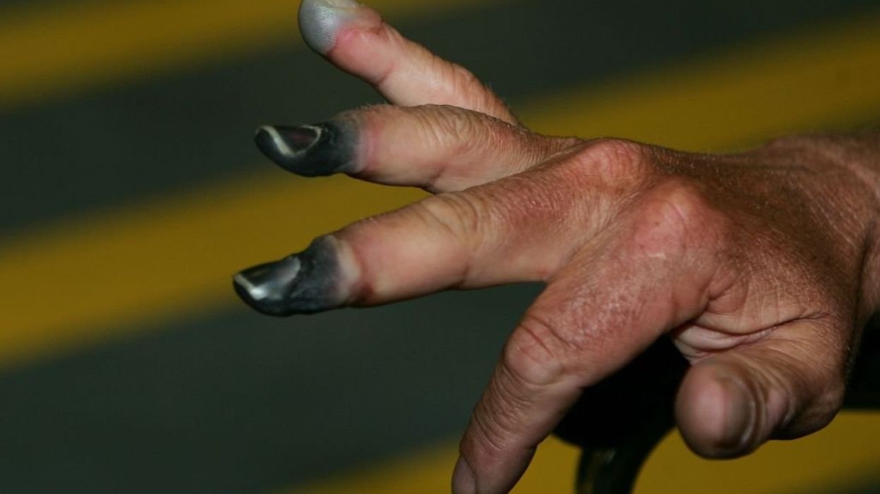 FDA greenlights use of medication to address severe frostbite