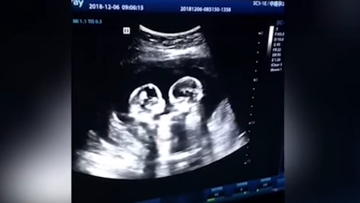 WATCH: Video shows unborn twins throwing punches in the womb