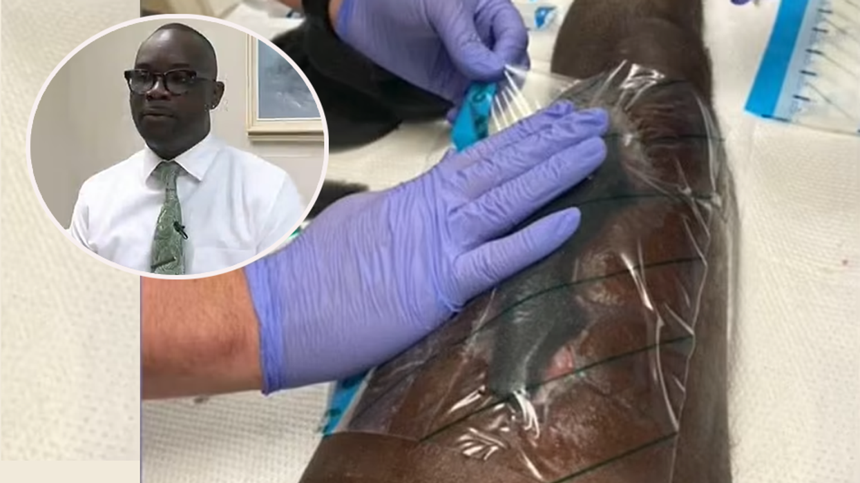 Man gets flesh-eating bacteria after he's bitten by family member during fight at family function