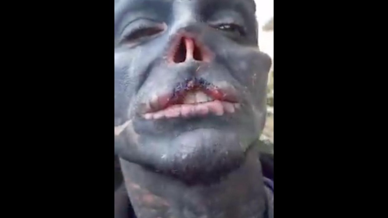 Man who wants to turn himself into a 'black alien' slices off his nose, top lip — and now struggles to speak properly