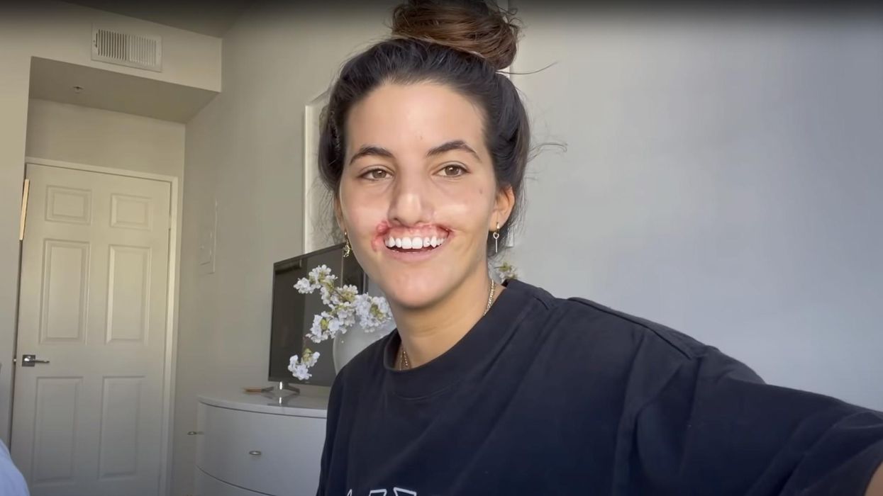 Model Brooklinn Khoury gets new lip after horror dog attack tore off upper lip, portion of nose 1 year ago