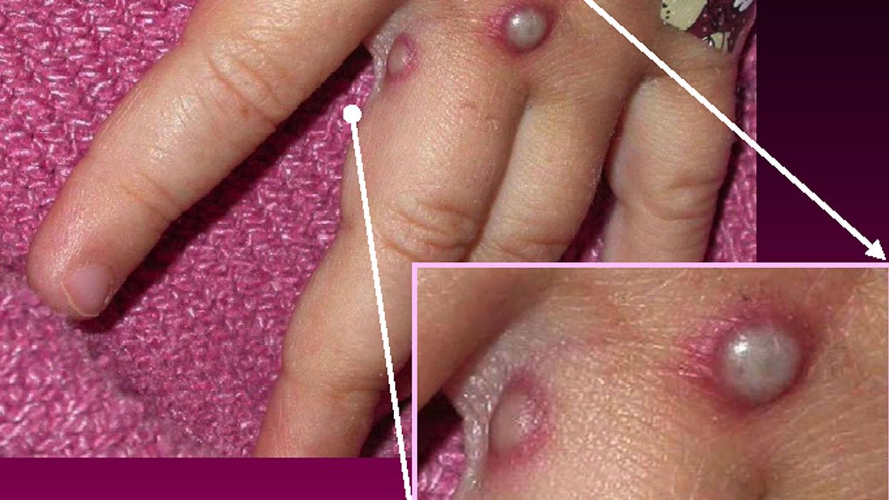 US government tracking more than 200 people in 27 states after they possibly came into contact with monkeypox